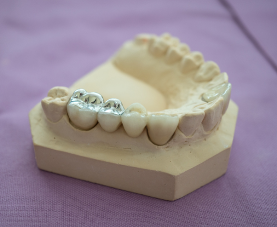 Amalgamat w zębie - czym jest, czy jest niebezpieczny?