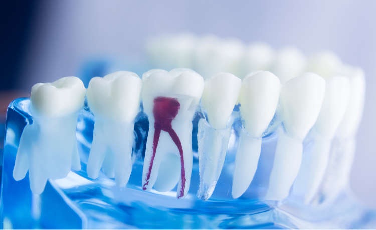 ile ząb ma korzeni a ile kanałów?