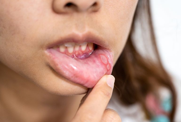 Opryszczkowe zapalenie jamy ustnej