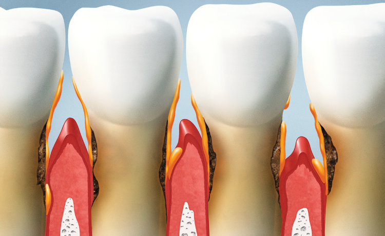Czym jest recesja dziąseł?