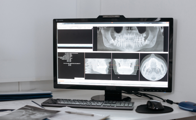 Tomografia komputerowa zębów - czym jest?