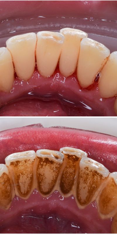 Skaling zębów przed i po