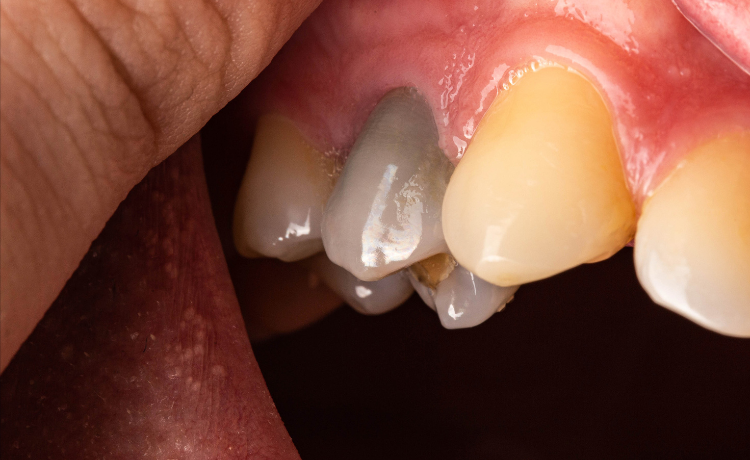 zapalenie miazgi zęba - martwica zęba